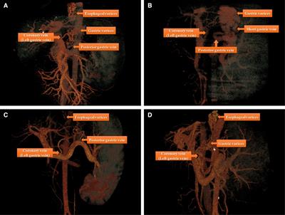 Individualized total laparoscopic surgery based on 3D remodeling for portal hypertension: A single surgical team experience